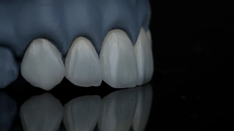 IPS EMAX veneer, Golden Dental Clinic