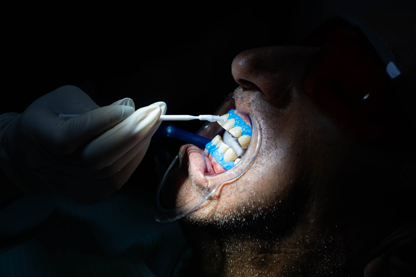 Professional Teeth Whitening