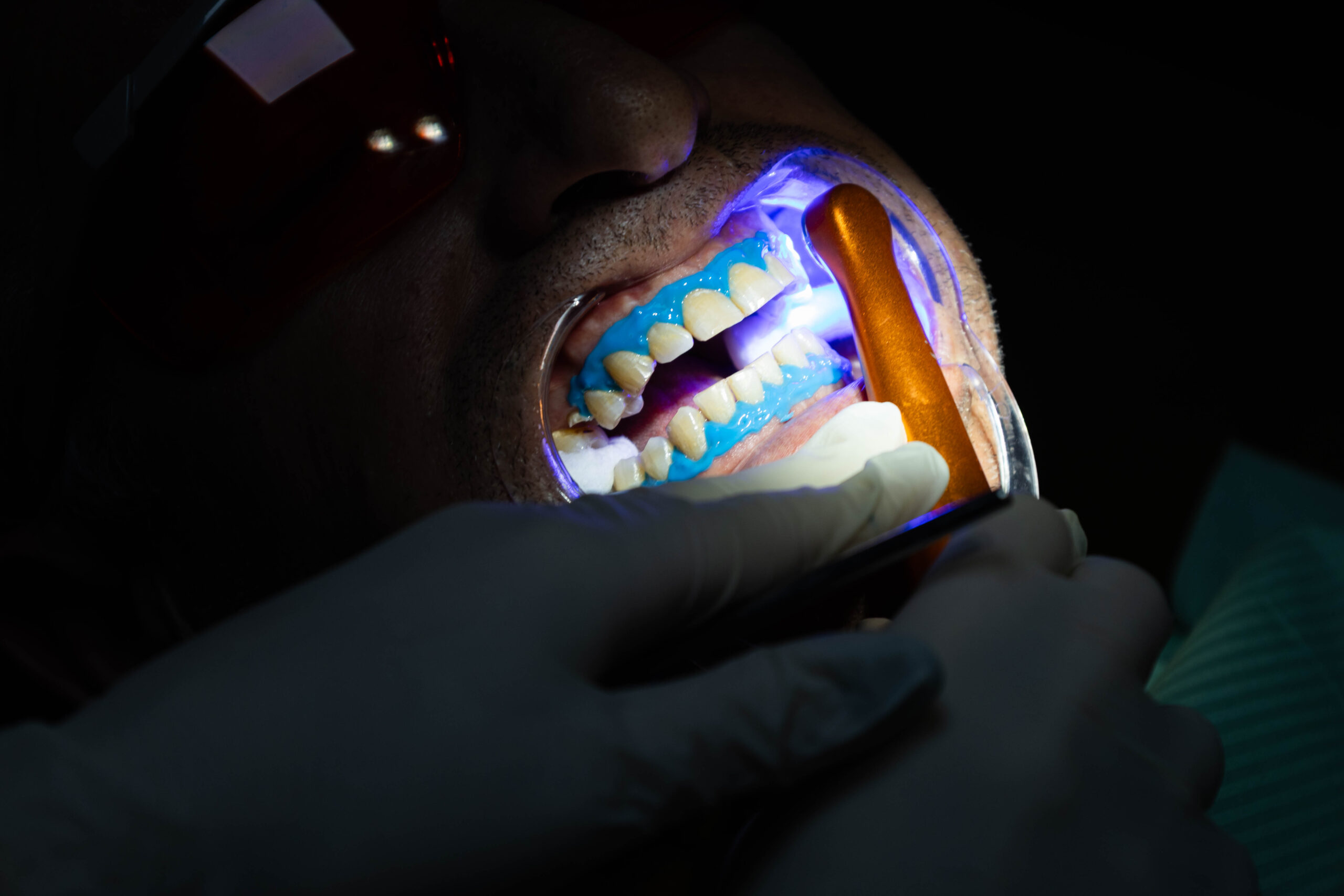 teeth withening - golden dental clinic